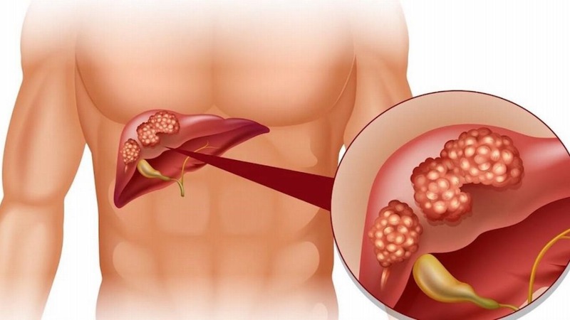 dấu hiệu nam giới cần thải độc gan